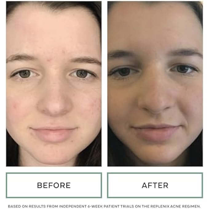 Replenix GLY-SAL 5-2 DEEP PORE FACIAL CLEANSER, MEDICAL-GRADE 5% GLYCOLIC & 2% SALICYLIC ACID OIL-FREE FACE WASH FOR ACNE-PRONE SKIN (6.7 FL. OZ) - Image 4